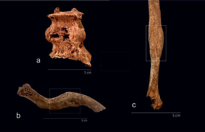 Figure 6. a) Lumbar vertebral ankylosis; b) Clavicle fracture; c) Ulna fracture.
