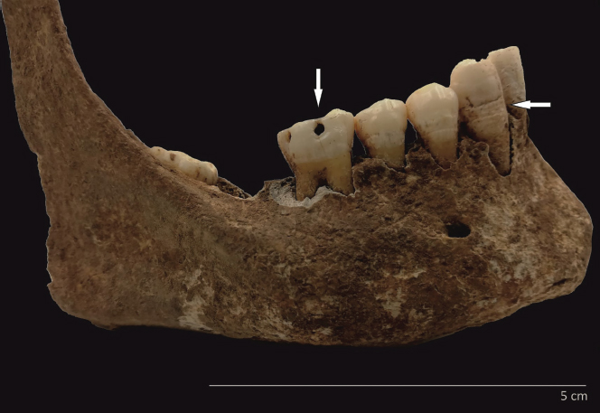 Figure 7. Dental caries and LEH in the mandibular dentition.