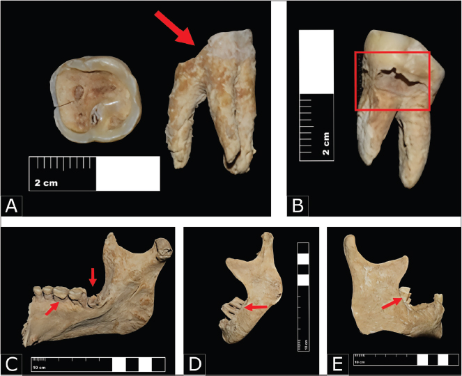 Figura 6. A. Desgaste dental (Individuo 10, Osario 3, EF. IX); B. Caries (Individuo 12, Osario3, EF IX); C. Caries, cálculo y retroceso alveolar causado por enfermedad periodontal presente en el Individuo 21 (Osario 6, EF. XIX); D. Así como en el Individuo 10 (Osario 3, EF IX); E. Individuo 17 (Osario 5, EF. XLVII).