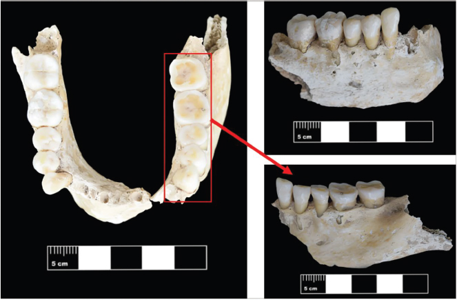 Figura 7. Desgaste dentario acentuado en la parte izquierda mandibular del Individuo 30.