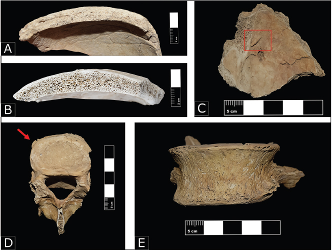 Figura 8. A y B. Engrosamiento del diploe del Individuo 6 y 23; C. Posible osteoma del Individuo 23; D. Osteofitos marginales en el cuerpo vertebral, Osario 4; E. Leve aplastamiento y osteofitos marginales de la vertebra dorsal D11, Osario 5.