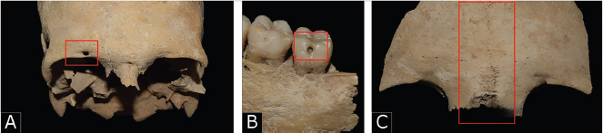 Figura 9. A. Foramen Supraorbital en el cráneo del Individuo 17; B. Foramen Caecum Molare del Individuo 28; C. Sutura metópica en el hueso frontal del Individuo 11.