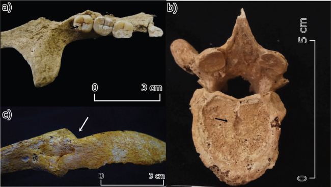 Ejemplo de patologías identificadas en la muestra estudiada; a) caries dental, b) nódulo de Schmörl, c) fractura ante mortem en una costilla